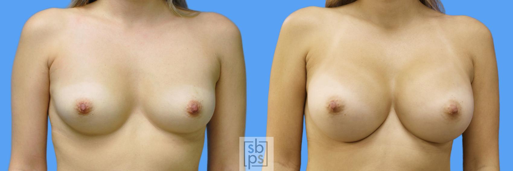 Before & After Breast Augmentation Case 172 View #1 View in Torrance, CA