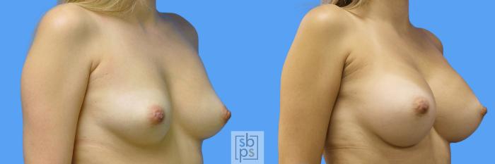 Before & After Breast Augmentation Case 172 View #2 View in Torrance, CA