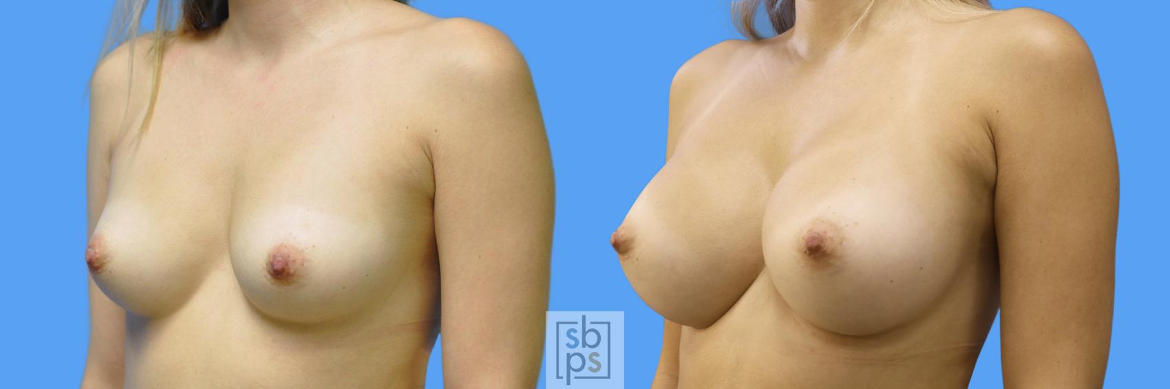 Before & After Breast Augmentation Case 172 View #3 View in Torrance, CA