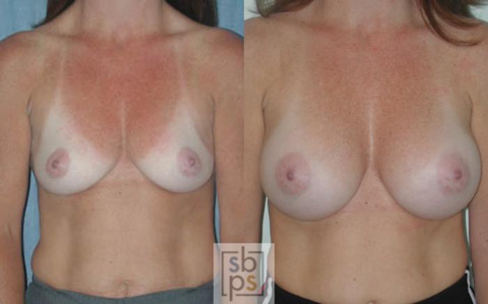 Before & After Breast Augmentation Case 18 View #1 View in Torrance, CA