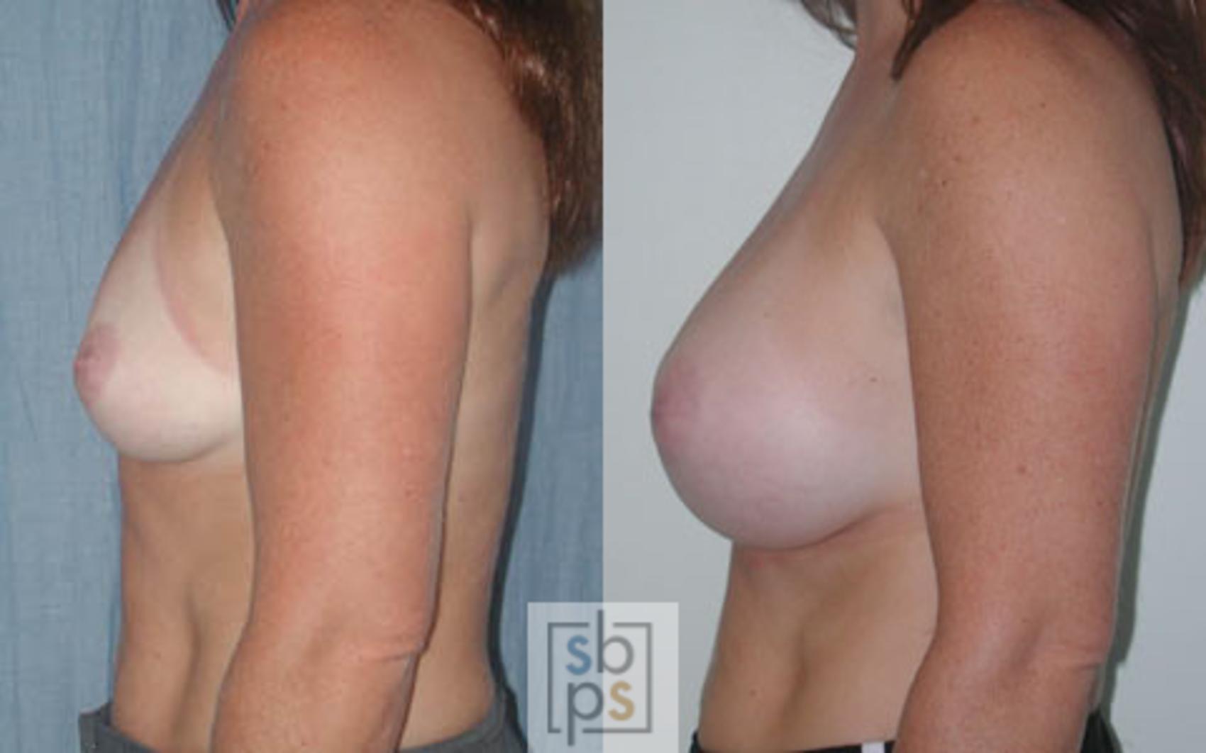 Before & After Breast Augmentation Case 18 View #2 View in Torrance & Los Angeles, CA, CA