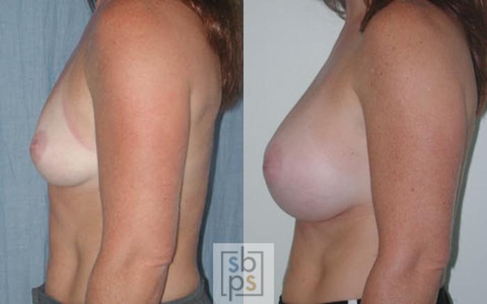 Before & After Breast Augmentation Case 18 View #2 View in Torrance, CA
