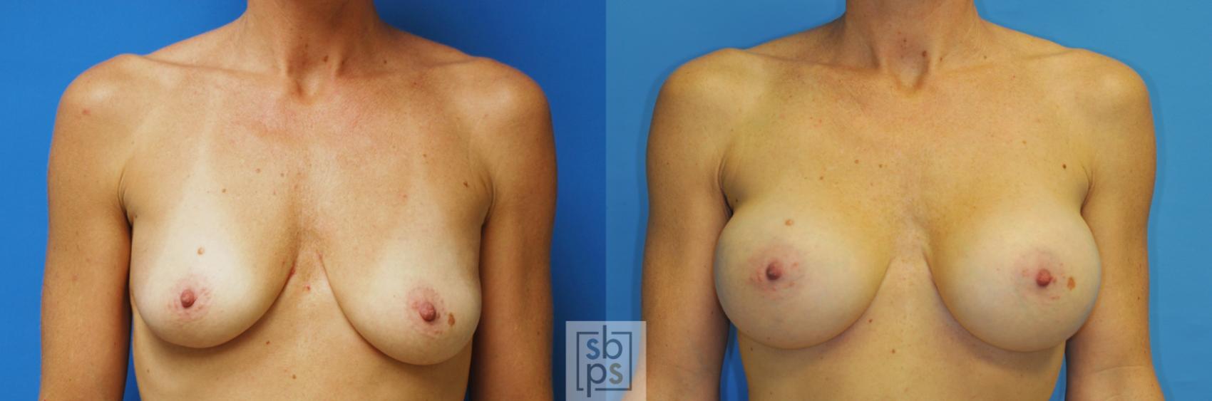 Before & After Breast Augmentation Case 182 View #1 View in Torrance, CA