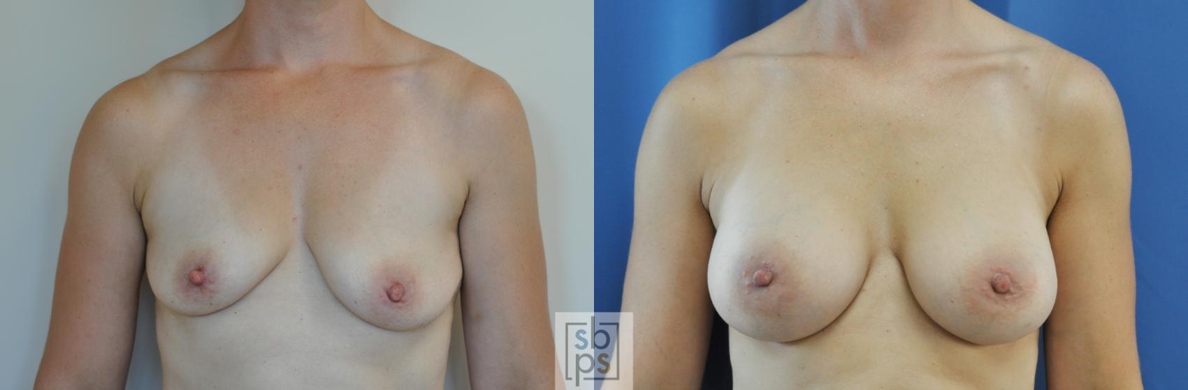 Before & After Breast Augmentation Case 184 View #1 View in Torrance, CA