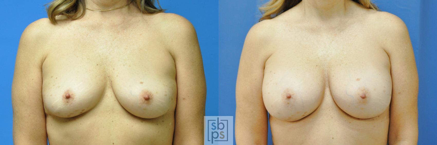 Before & After Breast Augmentation Case 186 View #1 View in Torrance, CA