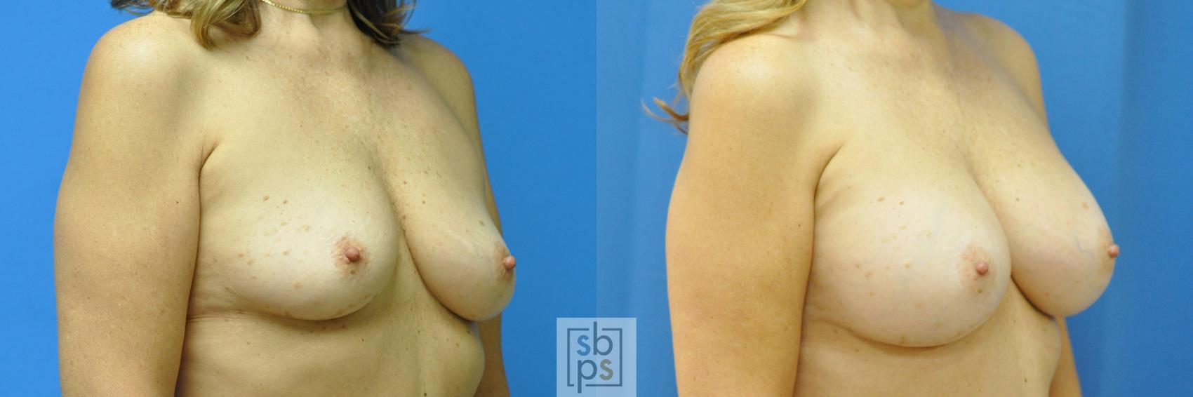 Before & After Breast Augmentation Case 186 View #2 View in Torrance & Los Angeles, CA, CA