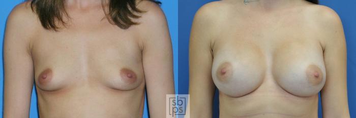 Before & After Breast Augmentation Case 187 View #1 View in Torrance, CA