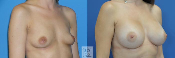 Before & After Breast Augmentation Case 187 View #2 View in Torrance, CA