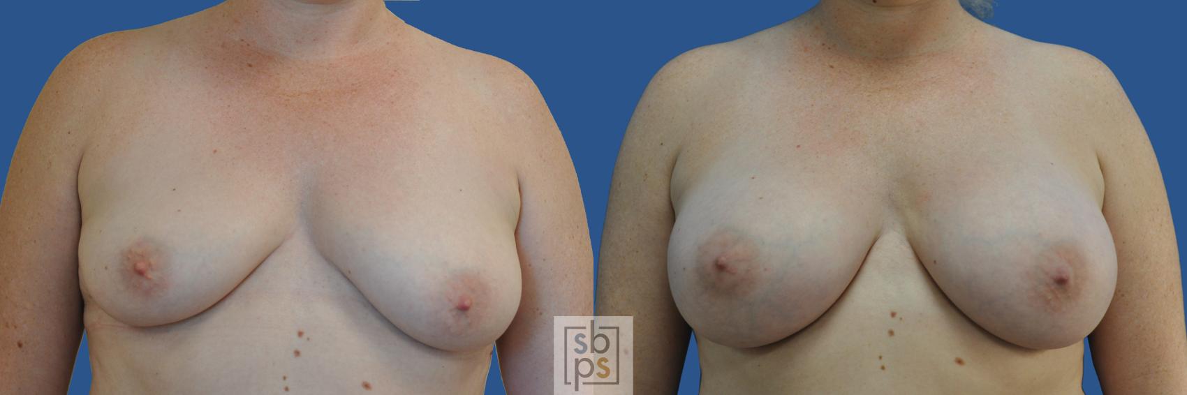Before & After Breast Augmentation Case 188 View #1 View in Torrance, CA