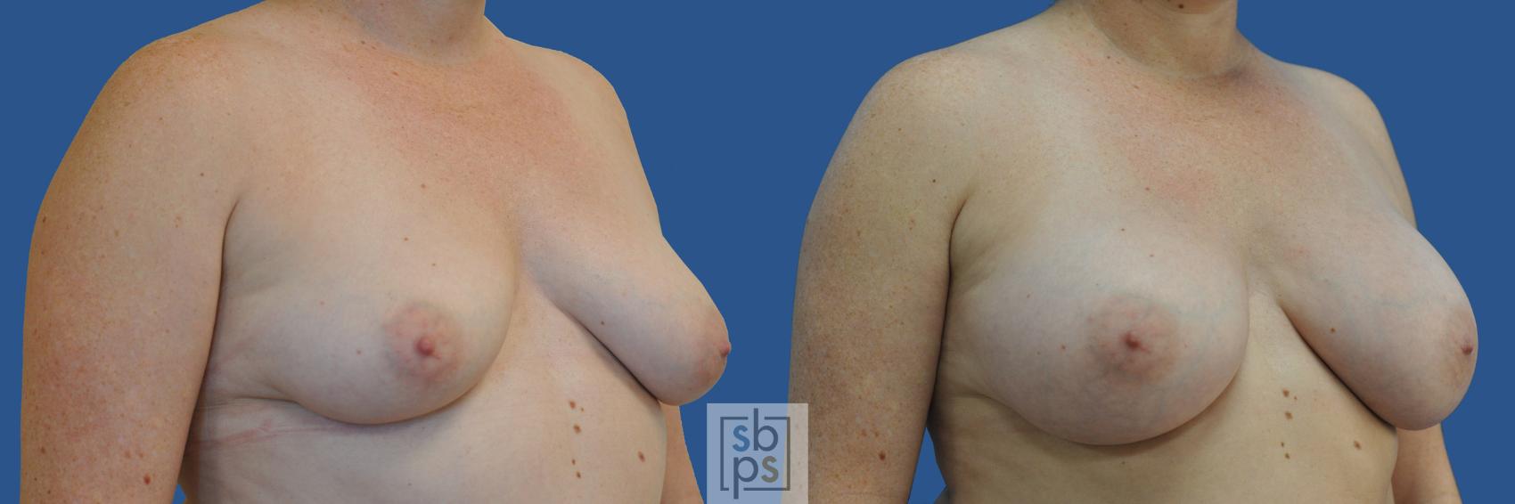 Before & After Breast Augmentation Case 188 View #2 View in Torrance & Los Angeles, CA, CA