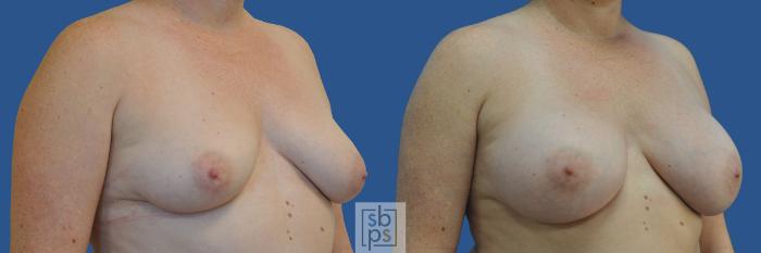 Before & After Breast Augmentation Case 188 View #2 View in Torrance, CA