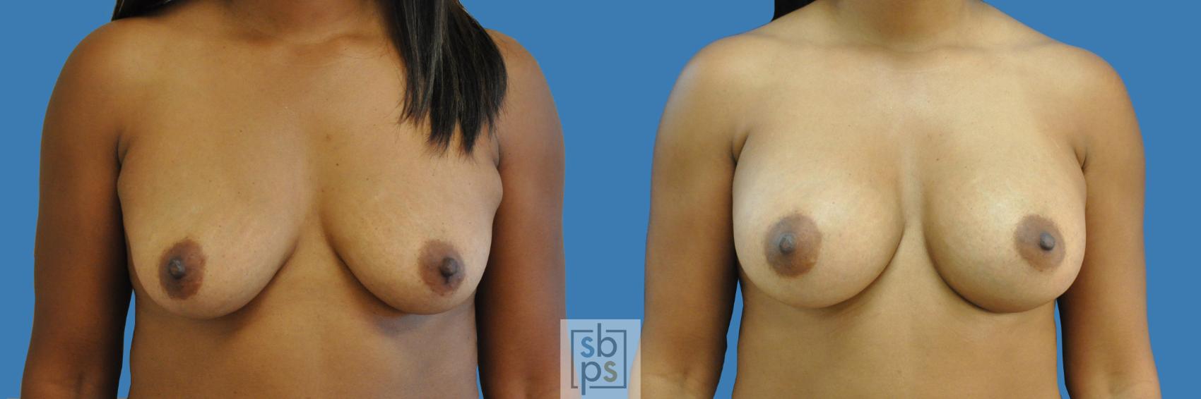 Before & After Breast Augmentation Case 194 View #1 View in Torrance, CA