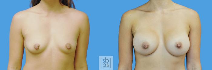 Before & After Breast Augmentation Case 196 View #1 View in Torrance, CA