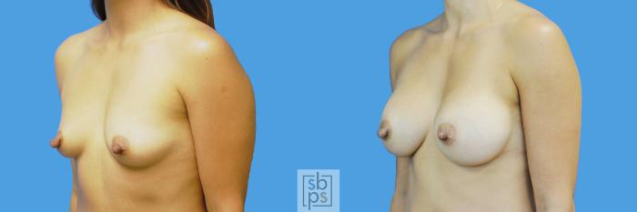 Before & After Breast Augmentation Case 196 View #2 View in Torrance, CA