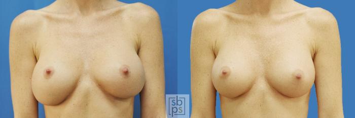 Before & After Breast Augmentation Case 197 View #1 View in Torrance, CA