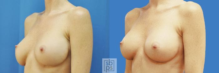 Before & After Breast Augmentation Case 197 View #2 View in Torrance, CA