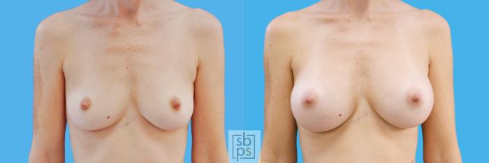 Before & After Breast Augmentation Case 200 View #1 View in Torrance, CA