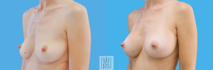 Before & After Breast Augmentation Case 200 View #2 View in Torrance, CA