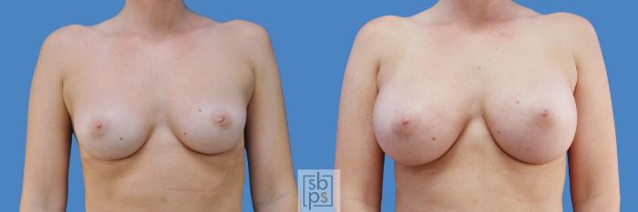 Before & After Breast Augmentation Case 201 View #1 View in Torrance, CA