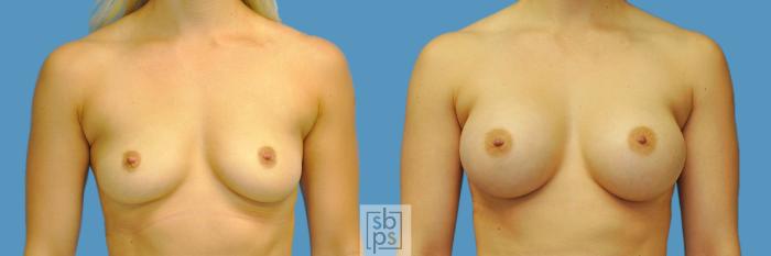 Before & After Breast Augmentation Case 203 View #1 View in Torrance, CA
