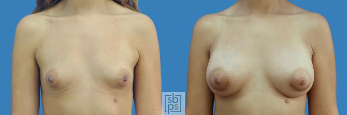 Before & After Breast Augmentation Case 207 View #1 View in Torrance, CA