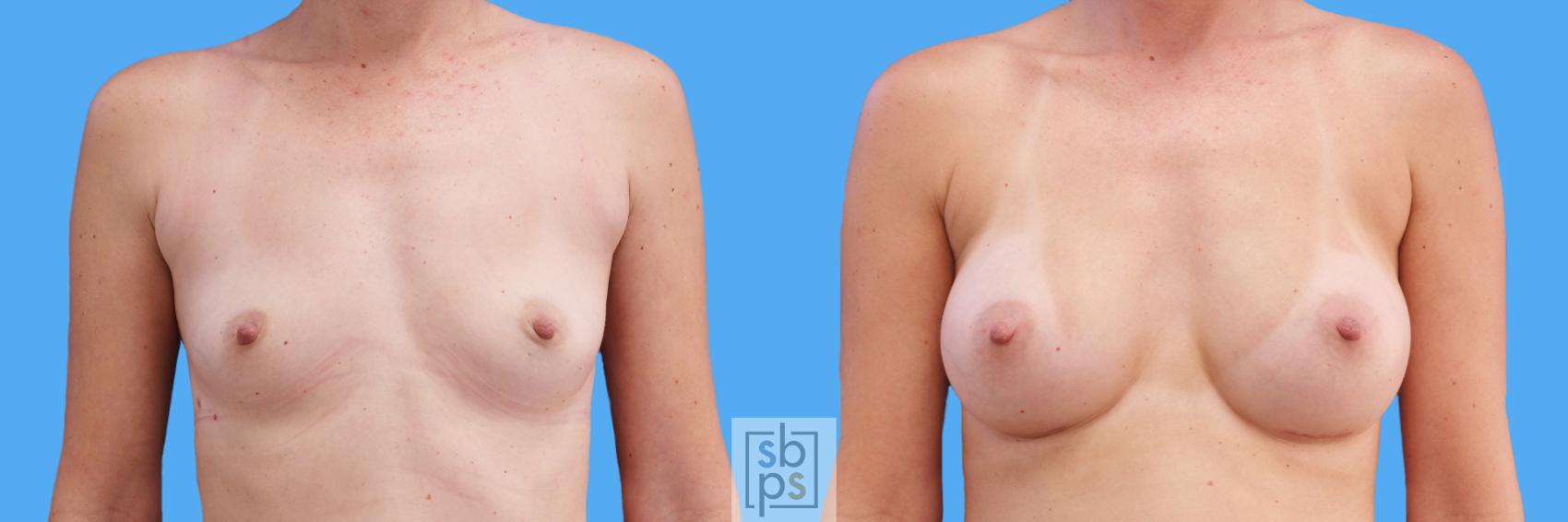 Before & After Breast Augmentation Case 211 View #1 View in Torrance, CA