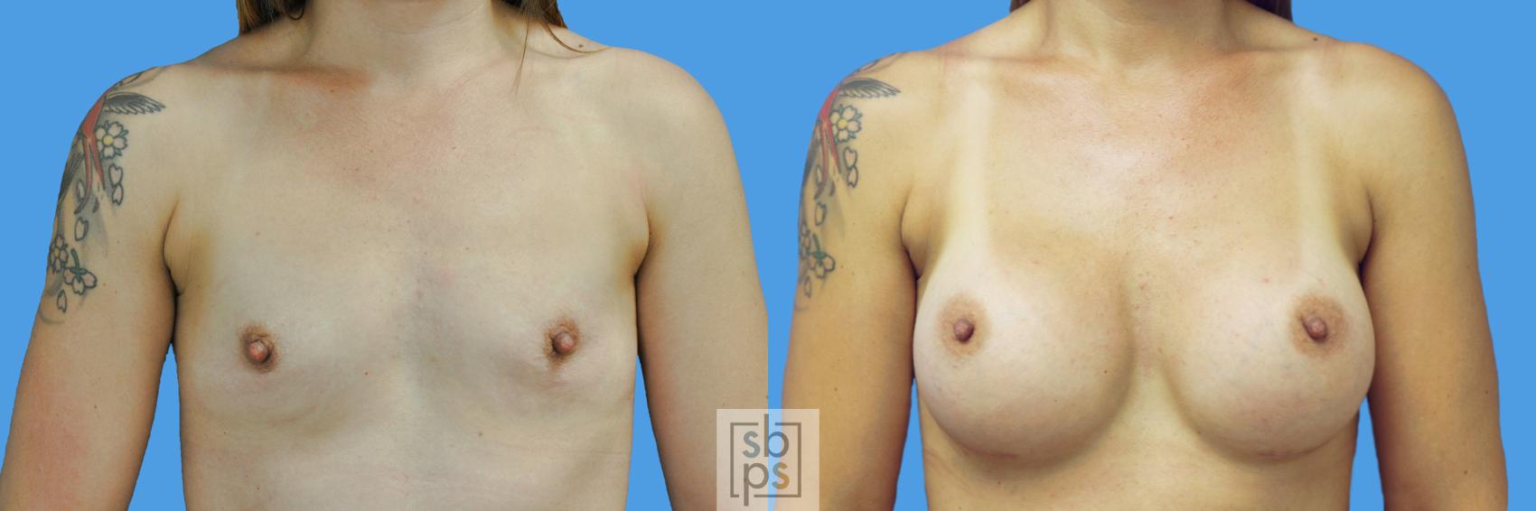 Before & After Breast Augmentation Case 212 View #1 View in Torrance, CA