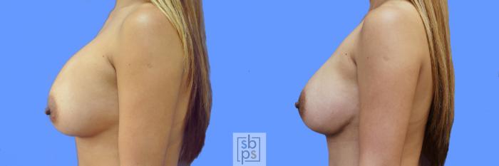 Before & After Breast Augmentation Case 214 View #2 View in Torrance, CA