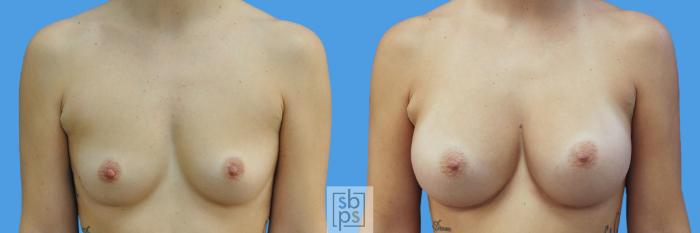 Before & After Breast Augmentation Case 216 View #1 View in Torrance, CA