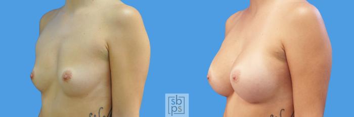 Before & After Breast Augmentation Case 216 View #2 View in Torrance, CA