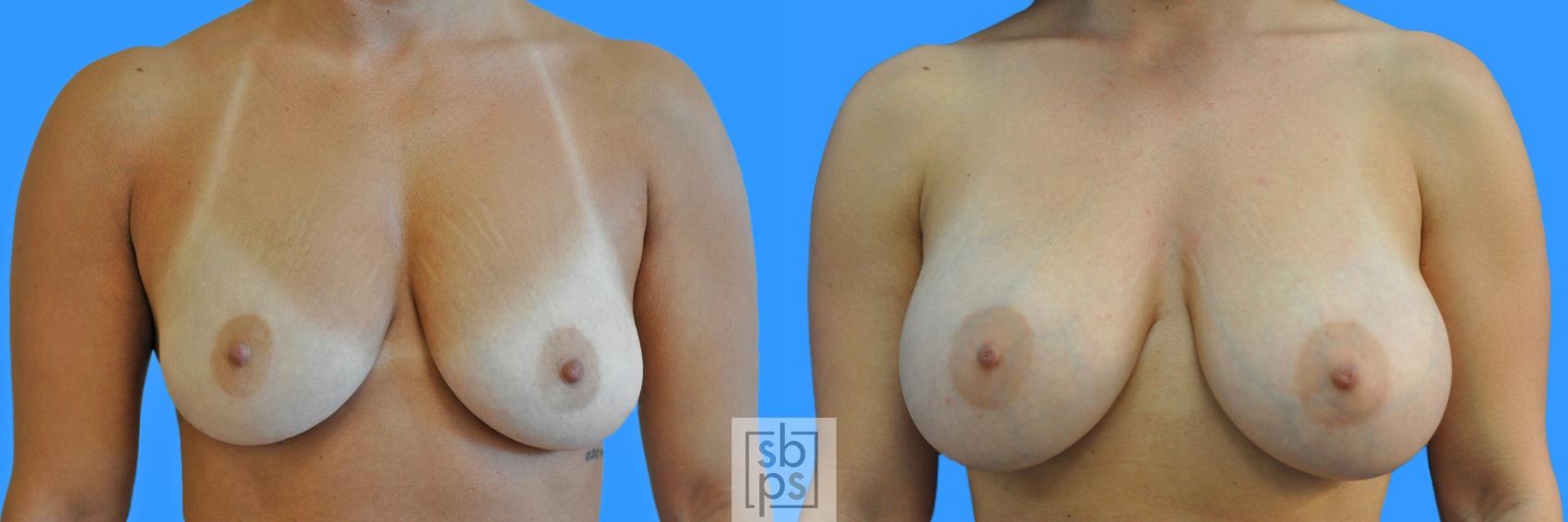 Before & After Breast Augmentation Case 220 View #1 View in Torrance, CA