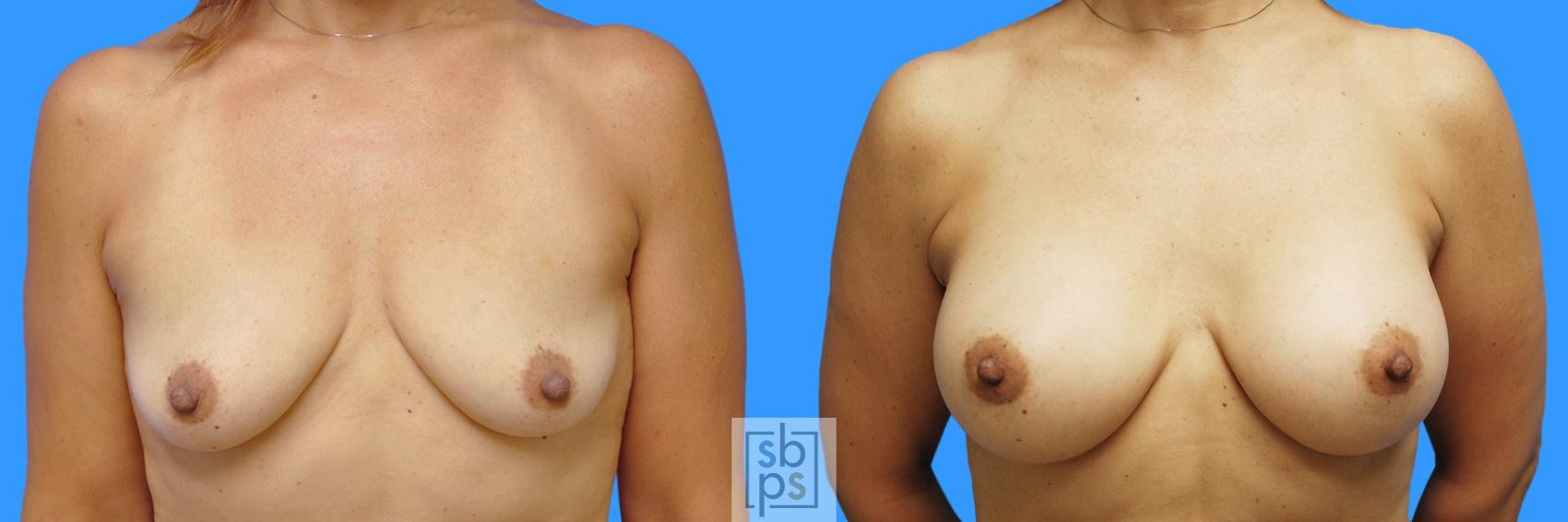 Before & After Breast Augmentation Case 222 View #1 View in Torrance, CA