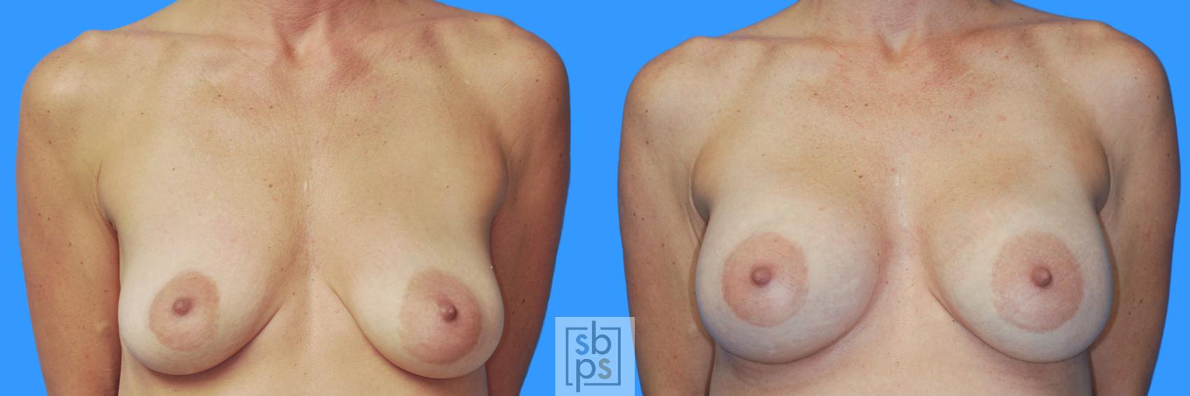 Before & After Breast Augmentation Case 227 View #1 View in Torrance, CA