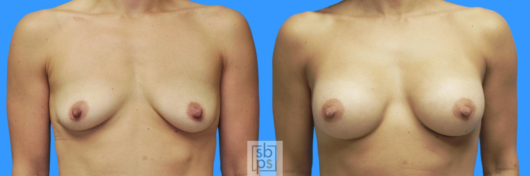 Before & After Breast Augmentation Case 228 View #1 View in Torrance, CA