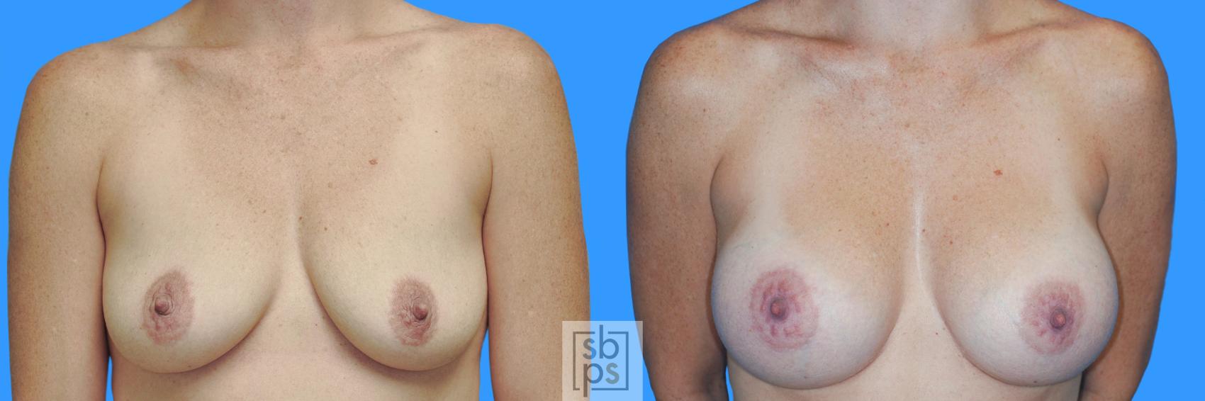 Before & After Breast Augmentation Case 229 View #1 View in Torrance, CA