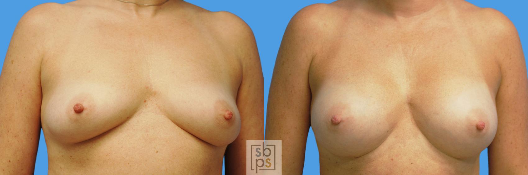Before & After Breast Augmentation Case 232 View #1 View in Torrance, CA