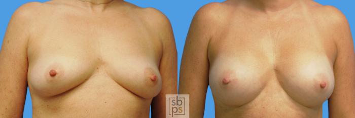 Before & After Breast Augmentation Case 232 View #1 View in Torrance, CA