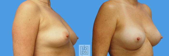 Before & After Breast Augmentation Case 232 View #2 View in Torrance, CA