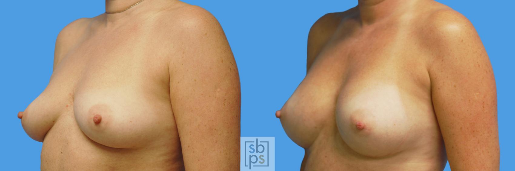 Before & After Breast Augmentation Case 232 View #3 View in Torrance & Los Angeles, CA, CA