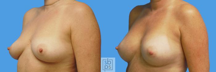 Before & After Breast Augmentation Case 232 View #3 View in Torrance, CA