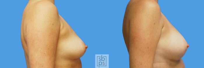 Before & After Breast Augmentation Case 232 View #4 View in Torrance, CA