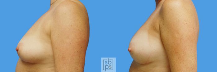 Before & After Breast Augmentation Case 232 View #5 View in Torrance, CA