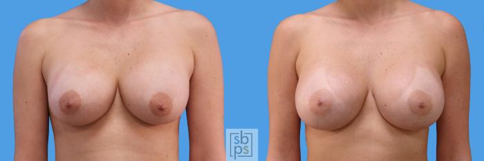 Before & After Breast Augmentation Case 233 View #1 View in Torrance, CA