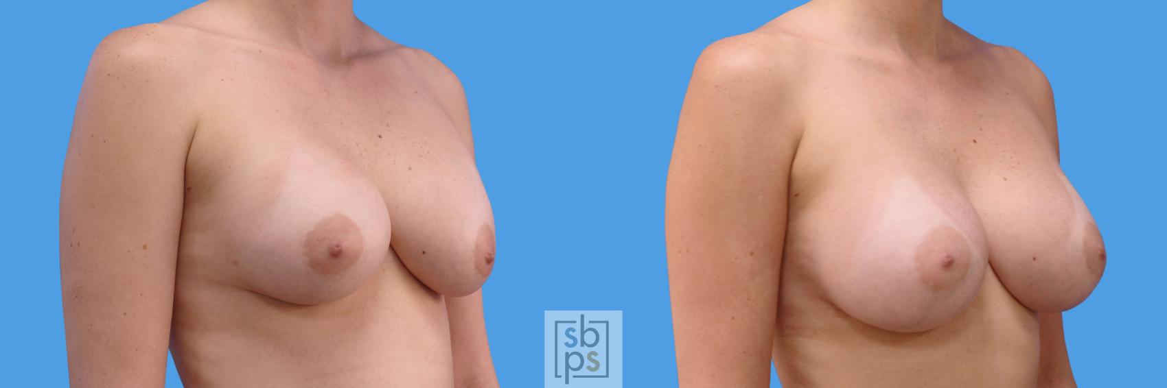 Before & After Breast Augmentation Case 233 View #2 View in Torrance & Los Angeles, CA, CA
