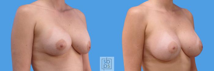 Before & After Breast Augmentation Case 233 View #2 View in Torrance, CA