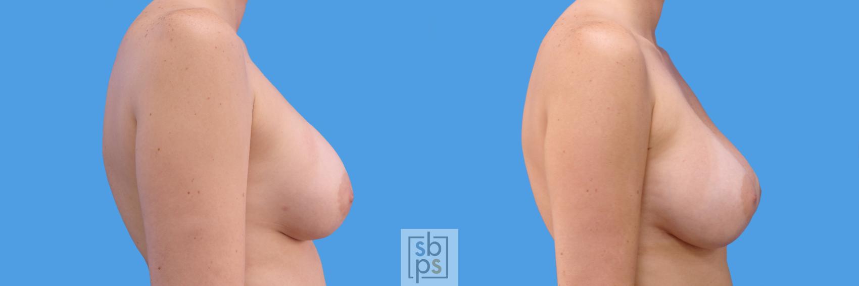 Before & After Breast Augmentation Case 233 View #3 View in Torrance & Los Angeles, CA, CA