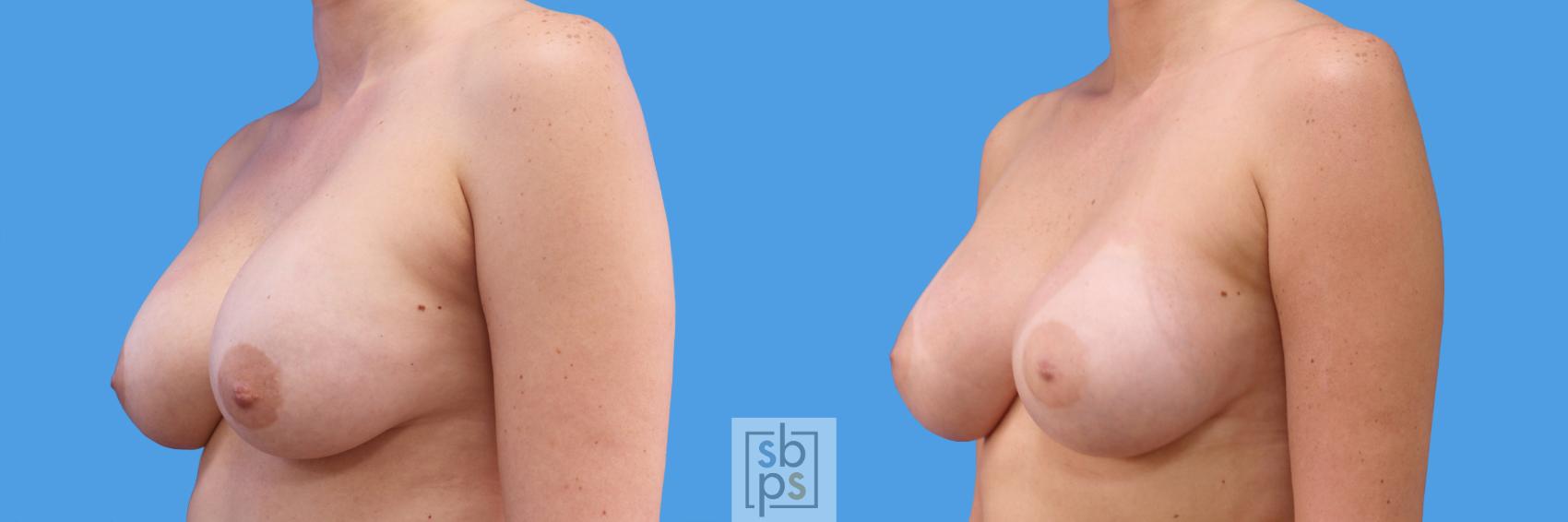 Before & After Breast Augmentation Case 233 View #4 View in Torrance & Los Angeles, CA, CA