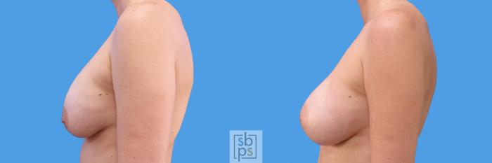 Before & After Breast Augmentation Case 233 View #5 View in Torrance, CA