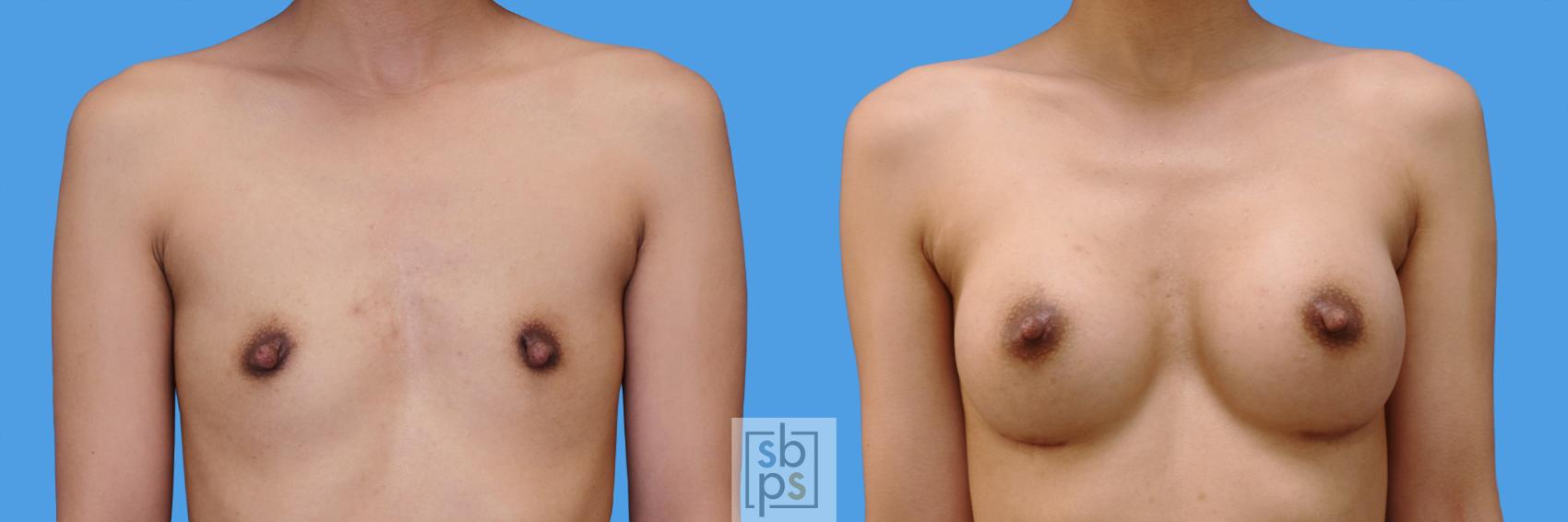 Before & After Breast Augmentation Case 240 View #1 View in Torrance, CA