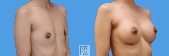 Before & After Breast Augmentation Case 240 View #2 View in Torrance, CA